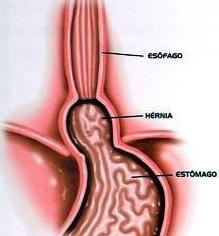 ACIDEZ, REFLUJO ÁCIDO, ÚLCERA y HERNIA DE HIATO