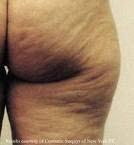 Alimentos para Eliminar la Celulitis no Infecciosa