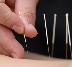 La acupuntura podría ayudar a aliviar los sofocos relacionados con el tratamiento del cáncer de próstata