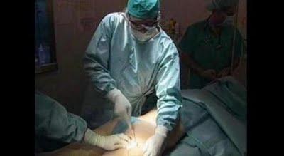 La liposucción pierde su 