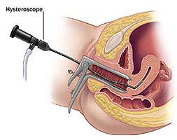¿Embarazo tras un legrado?