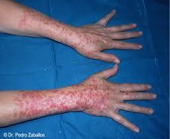 Detectando las alergias