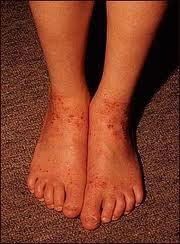 Detectando las alergias