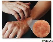 Detectando las alergias