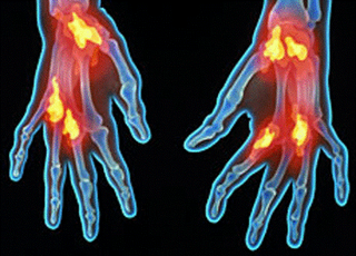 Artritis Reumatoide, tratamiento oportuno evita lamentables desenlaces