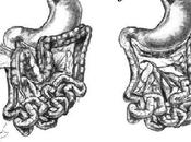 Mala rotación intestinal