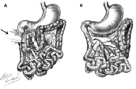 Mala rotación intestinal