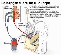 La máquina corazón/pulmón artificial en cirugía cardíaca (anestesia cardiovascular IV)