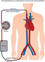 La máquina corazón/pulmón artificial en cirugía cardíaca (anestesia cardiovascular IV)