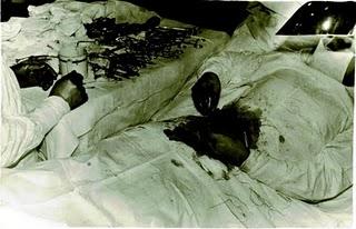 Apendicitis: operar, no operar...o autooperarse