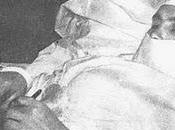 Apendicitis: operar, operar...o autooperarse