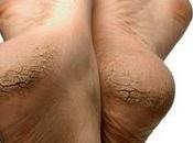 ¿Talones agrietados?