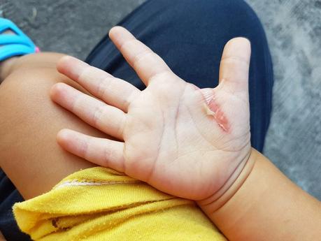 Curar heridas por quemaduras a los niños