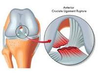 Reparación de Ligamentos usando el procedimiento BEAR