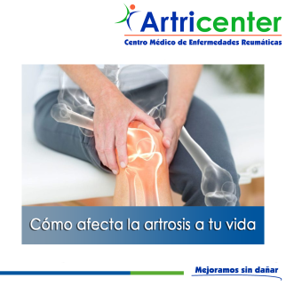 Artricenter: Cómo afecta la artrosis a tu vida Artricenter: Cómo afecta la artrosis a tu vida