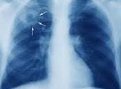 Inmunoterapia Puede Eficaz para Combatir Tuberculosis