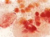 Microbioma Vagina determina riesgo contraer