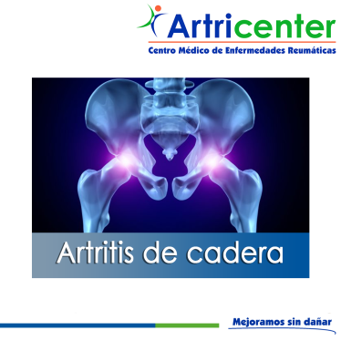 Artricenter: Artritis de cadera