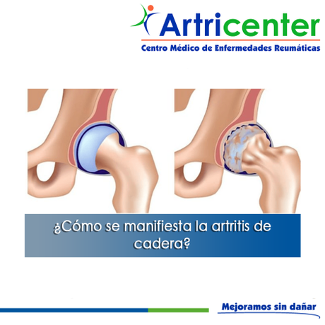 Artricenter:  ¿Cómo se manifiesta la artritis séptica de cadera?