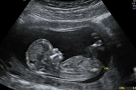 #Ciencia: Una #bebé nace “embarazada” de su hermano gemelo #Medicina #Salud #Barranquilla #Colombia