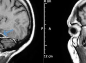 cerebro usar hisopos para limpiarse oídos