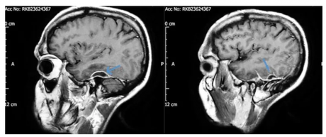Pus en el cerebro por usar hisopos para limpiarse los oídos