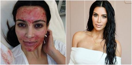 Las operaciones de #KimKardashian que la hacen lucir una espectacular figura #Belleza #Mujeres #Botox #Estetica #Kardashian (FOTOS)