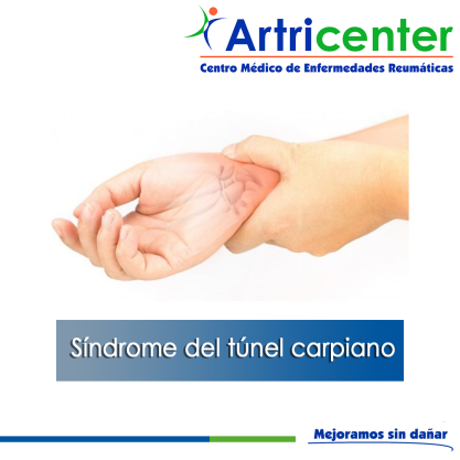 Artricenter: Síndrome del túnel carpiano