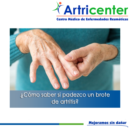 Artricenter: ¿Cómo saber si padezco un brote de artritis?