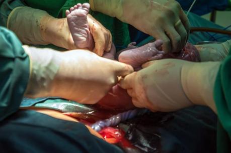 Parto por cesárea: ¿bueno o malo?