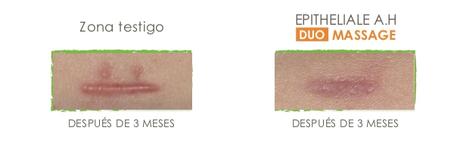 Epitheliale A.H. DUO Massage es la Solución de A-Derma para las Cicatrices y Estrías