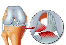 Lesión del ligamento cruzado: causas, síntomas, cirugía y tiempo de recuperación de LCA