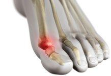 ¿Qué es el dedo de césped y cómo lo tratas? El dedo gordo puede causar dolor e hinchazón alrededor del dedo gordo