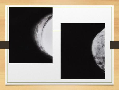 PROYECCIONES MASTOGRAFICAS