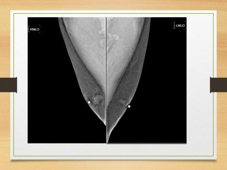 PROYECCIONES MASTOGRAFICAS