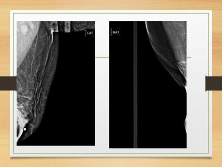 PROYECCIONES MASTOGRAFICAS