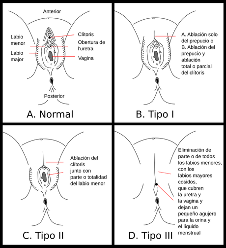 Mutilación genital femenina, una lacra permanente