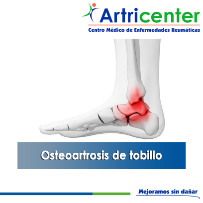 Artricenter: Osteoartrosis de tobillo