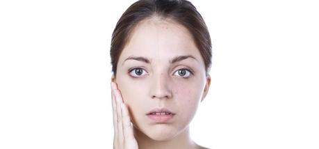 Esclerodermia o fenómeno Raynaud