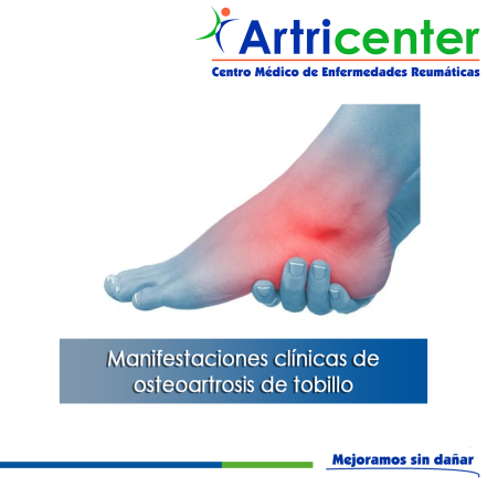 Artricenter: Manifestaciones clínicas de osteoartrosis de tobillo.