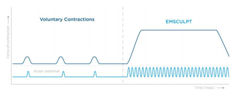 EMSCULPT: LA MAQUINA DE LAS 20.000 ABDOMINALES. 9 VERDADES BASADAS EN NUESTRA EXPERIENCIA EN MADRID CON LOS PRIMEROS 100 PACIENTES EMSCULPT: LA MAQUINA DE LAS 20.000 ABDOMINALES. 9 VERDADES BASADAS EN NUESTRA EXPERIENCIA EN MADRID CON LOS PRIMEROS 100 PACIENTES