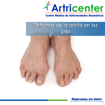 Artricenter: Síntomas de la artritis en los pies Artricenter: Síntomas de la artritis en los pies