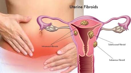 fibroma uterino tratamiento,

cuando se opera un fibroma uterino,

sintomas de fibromas y quistes,

fibroma uterino fotos,

fibroma uterino embarazo,

porque se forman los fibromas,

los fibromas en el utero son peligrosos,

fibromas en los ovarios