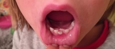 ¡¡La caída de los primeros dientes ha llegado!!