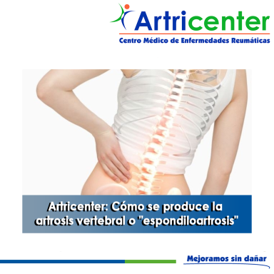 Artricenter: Cómo se produce la artrosis vertebral o “espondiloartrosis”