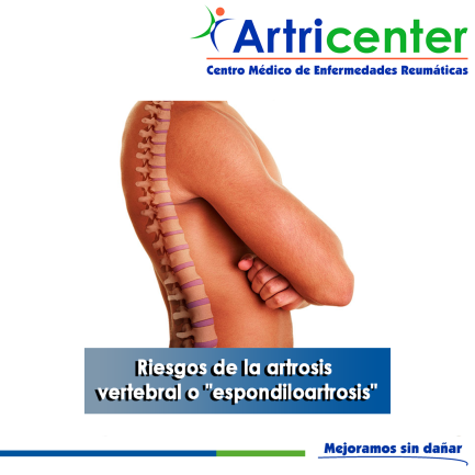 Artricenter: Riesgos de la artrosis vertebral o “espondiloartrosis”