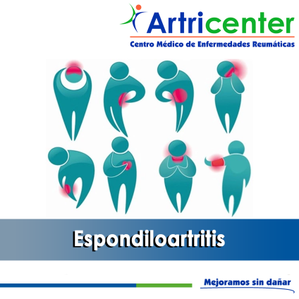 Artricenter: Espondiloartritis