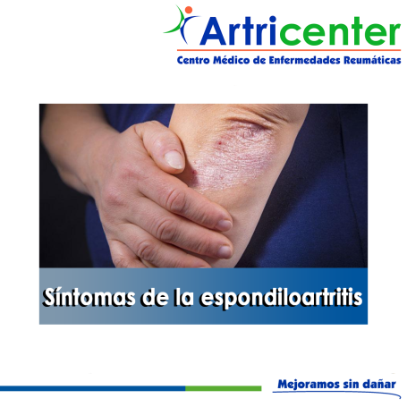 Artricenter: Síntomas de la espondiloartritis