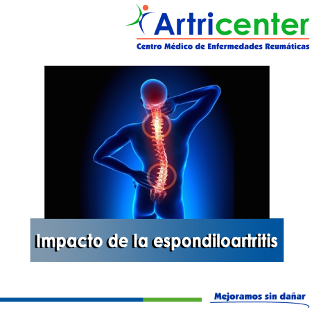 Artricenter: Impacto de la espondiloartritis