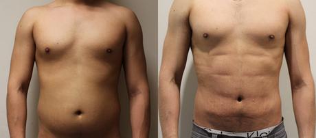 #Mexico: ¿Cuáles son las #cirugías #plásticas que más solicitaron los #funcionarios publicos mexicanos?